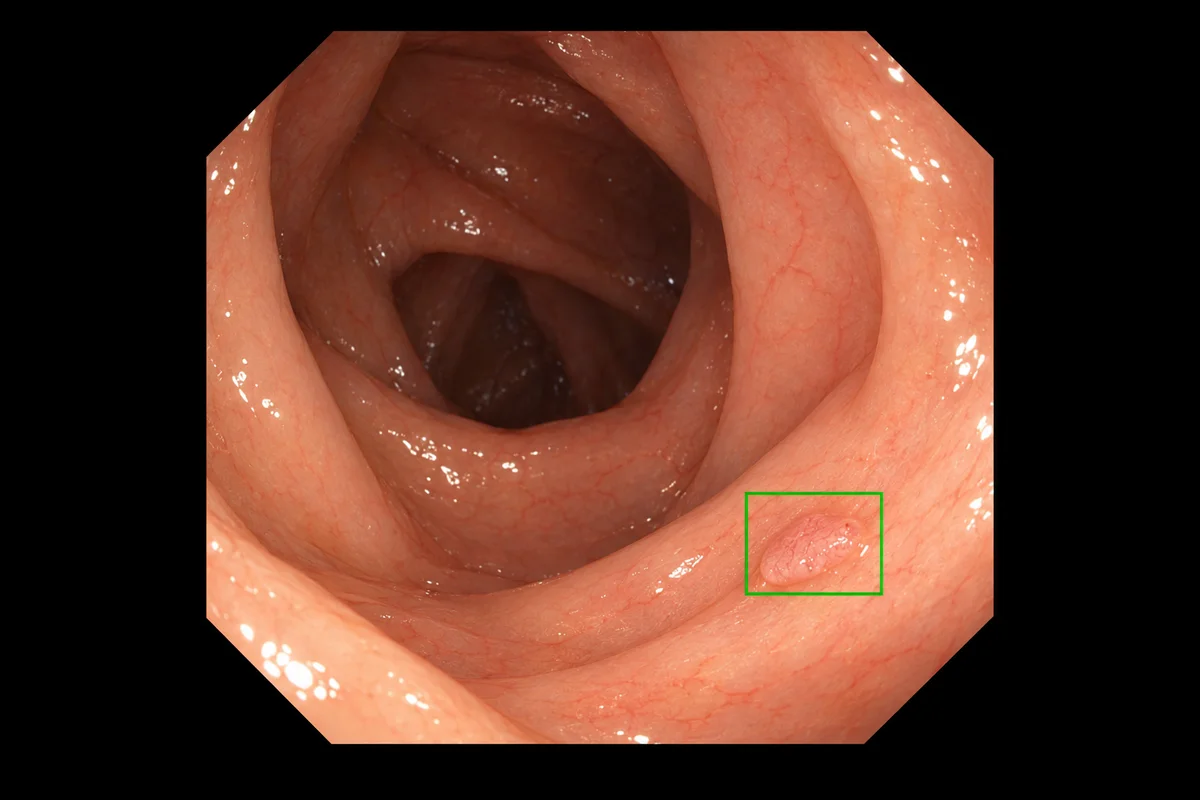 Camera view inside the colon with a thin green box drawn around a small polyp